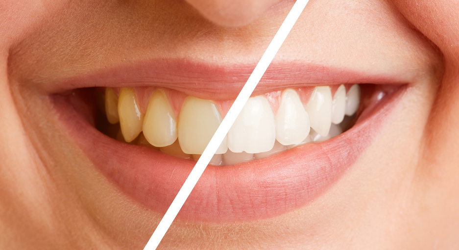 Dentcoat als mineralisierender Schutz für die Zähne 