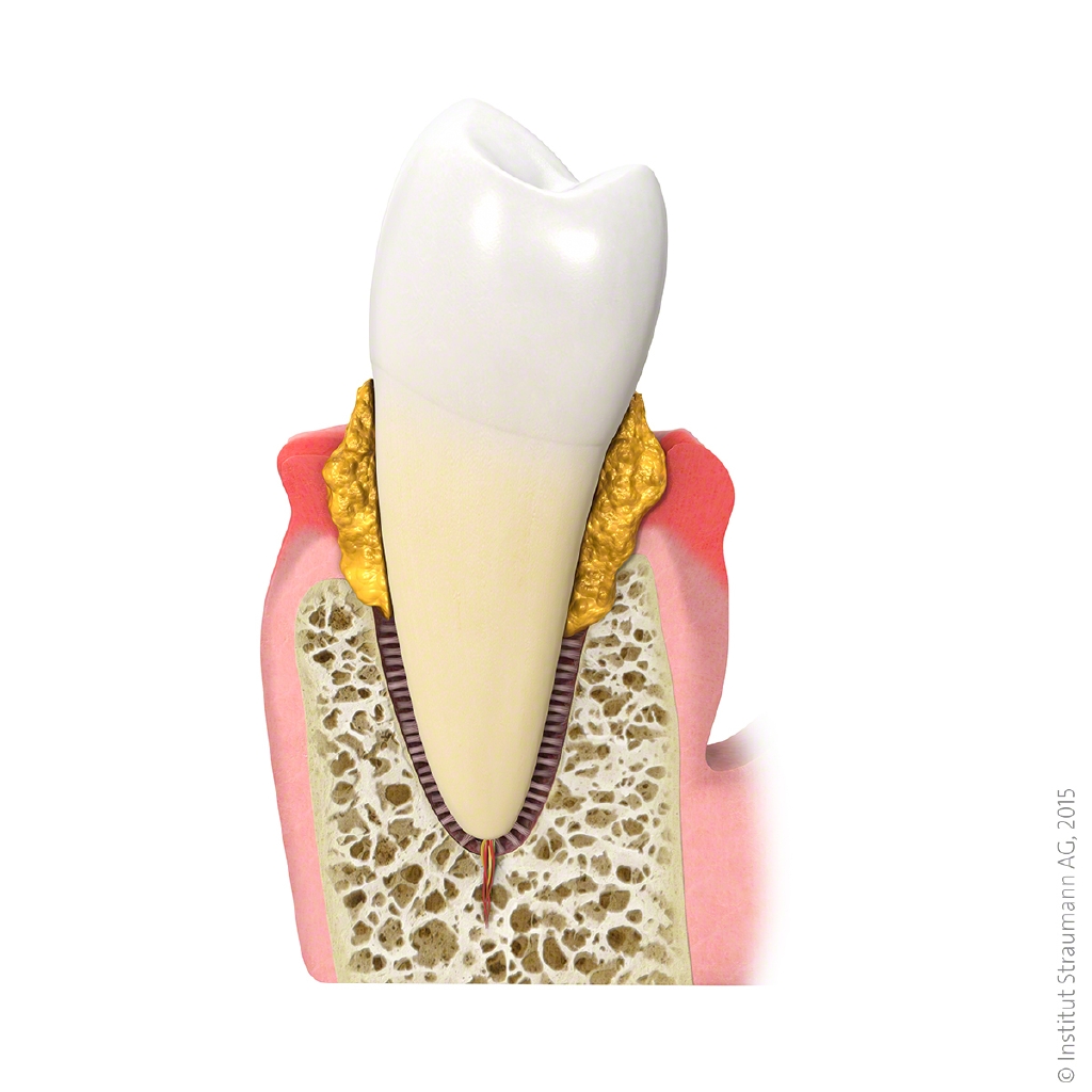 Prodontitis mit Zahnfleischentzündung